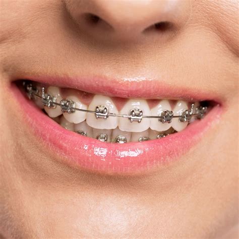 All Braces Types