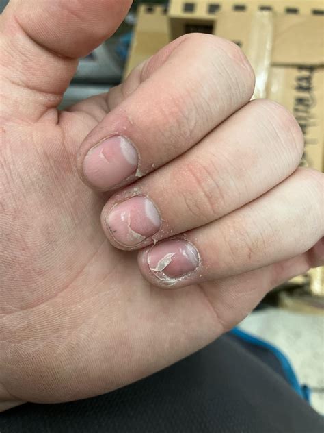Reasons Why Fingernails Fall Off