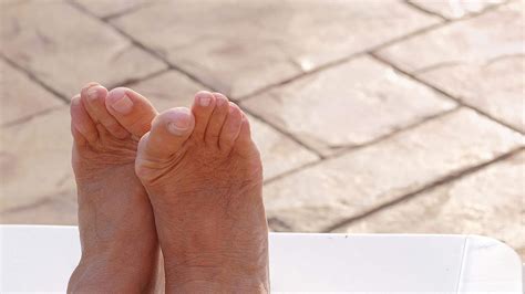 Hallux Rigidus treatment in Suffolk | Dale Halford | Total Foot Surgery