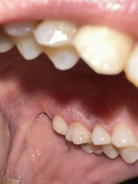 What’s on the roof of my mouth??? Burned skin? Ulcer? : r/DentalHygiene