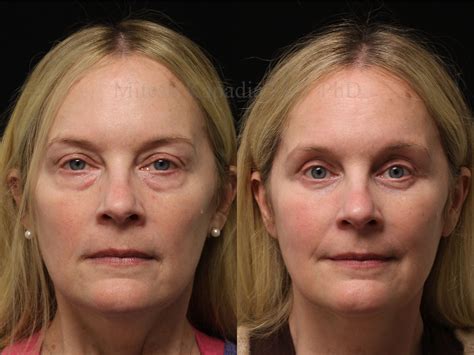 Before and six weeks after lower blepharoplasty surgery | Boston Eyelid Surgery