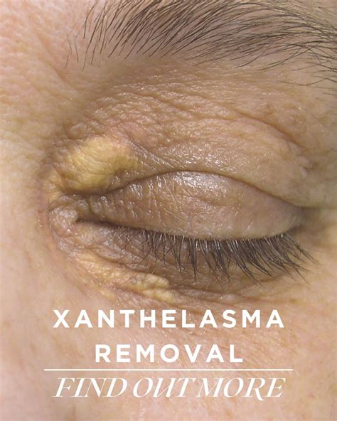 Xanthelasma Removal Brisbane | Yellow Bumps on Eyelid Treatment