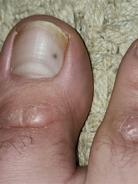 Black dot under toenail. What does this look like? 29 M : r/DermatologyQuestions