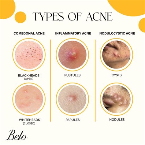 Understanding Acne: Common Types and Triggers