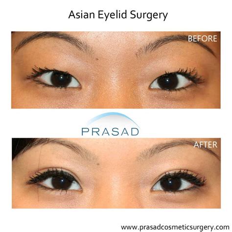 How is a Double Eyelid/ Eyelid Crease Created? | Dr. Prasad Blog