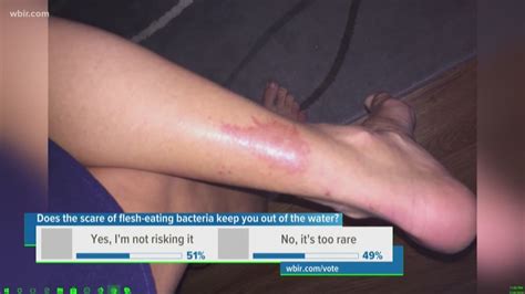 Health officials: 'Flesh-eating' infections are extremely rare | wbir.com