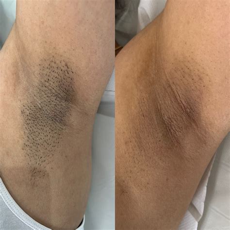 Laser hair removal - Jasthetics Clinic