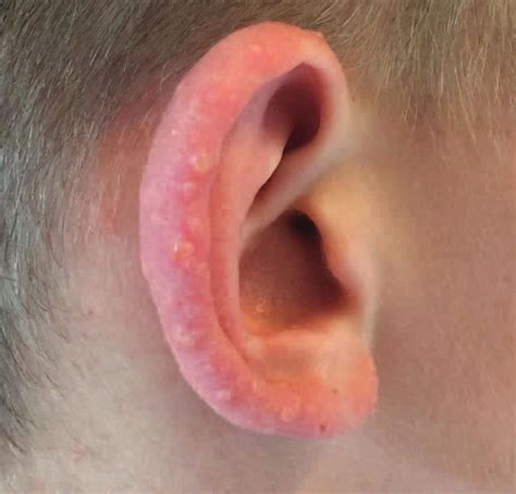 Juvenile spring eruption, causes, symptoms, diagnosis & treatment