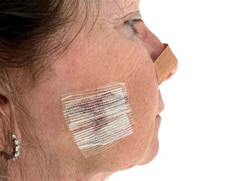 Mohs Procedure: A Skin Cancer Surgery Treatment that Works | Dermatology and Skin Health - Dr ...