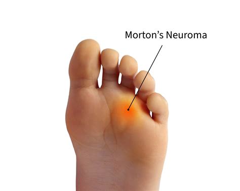 Morton's Neuroma in New York and Lake Success, NY | Performance Footcare of New York, PC