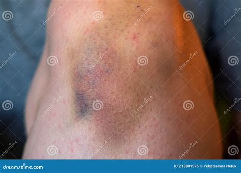 Bruise Injury on Knee. Close Up Image of Person Sitting on Sofa and Holding in Hands Wounded Leg ...