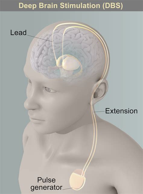 Deep Brain Stimulation | Conditions & Treatments | UT Southwestern Medical Center