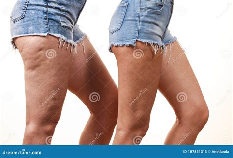 Cottage Cheese Legs Tumblr