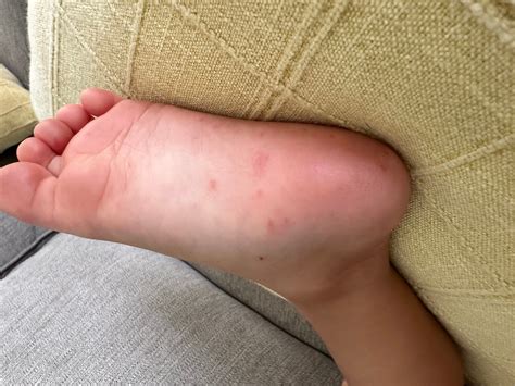 Freckles On Bottom Of Feet