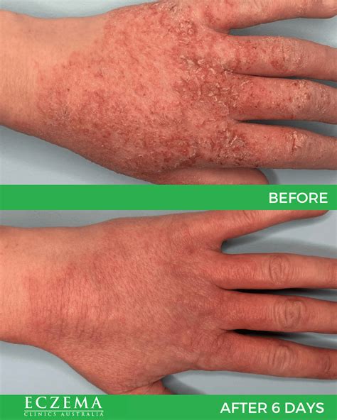 Eczema Specialist Gallery - Eczema Clinics Australia
