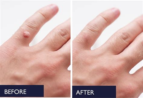 Maximum Strength Fast-Acting Liquid Wart Gel with Salicylic Acid - For Various Types of Warts ...