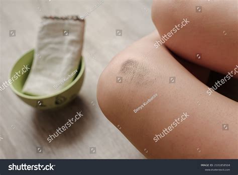 Physical Injury Female Knee Contusion Bruise Stock Photo 2101858504 | Shutterstock