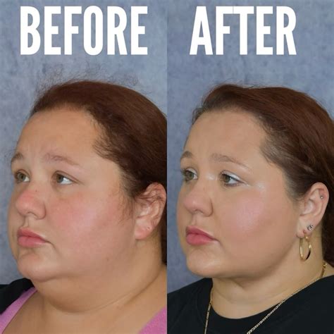 SAGAR PATEL MD Buccal l Chin Lipo l Ear Pinning | INCREDIBLE RESULTS! 😱 ...