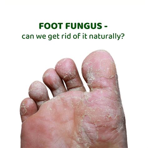 Athlete’s Foot (fungal infection) - Monisha Mantra