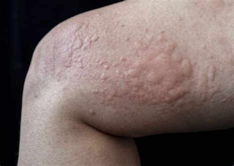 50 Facts About Papular Urticaria - Facts.net