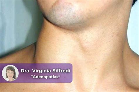 Ganglios Inflamados: Causas, Síntomas Y Tratamiento | Doctor Online