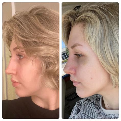Before and After, day 10 recovery from my Rhinoplasty, Chin augmentation, buccal fat removal and ...
