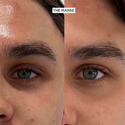 PRP (Platelet Rich Plasma) - THE MANSE CLINIC