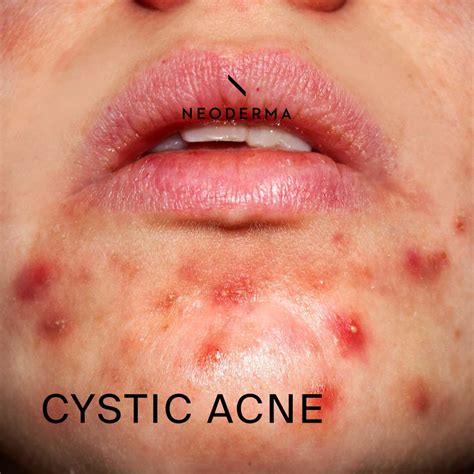 Cystic Acne – NEODERMA