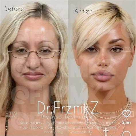 Pin by vickii on asurrealium🐚 in 2025 | Celebrity plastic surgery, Face surgery, Plastic surgery