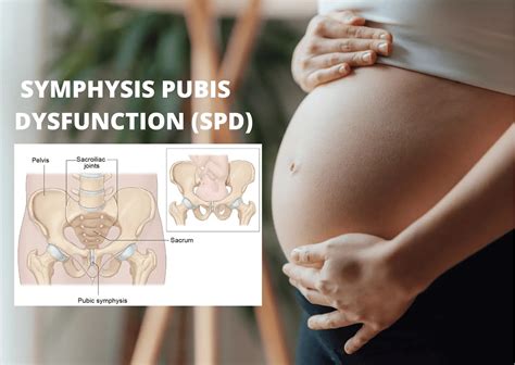 Symphysis Pubis Dysfunction (SPD) - Orchard Health Clinic - Osteopathy, Physiotherapy and ...