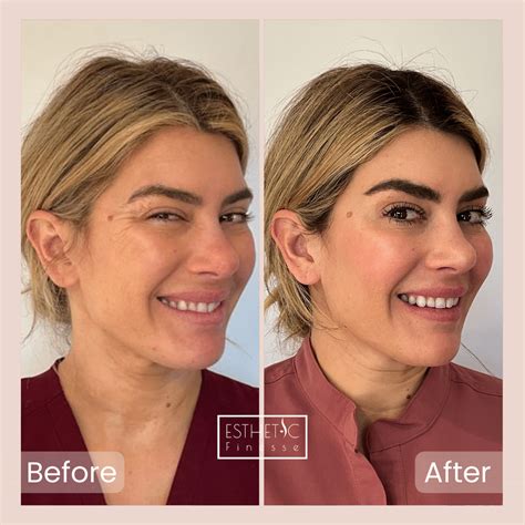 Nose Slimming Botox in Scottsdale and Paradise Valley- Esthetic Finesse