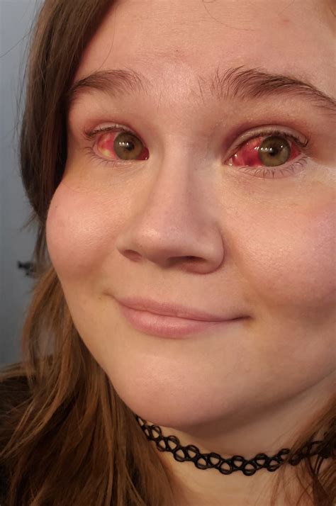 puked so hard the blood vessels in my eyes burst : r/Wellthatsucks