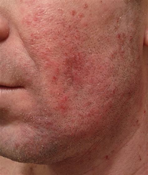 Webinar 001 | FCT Field Control Therapy