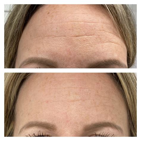Microneedling Before and After Results - Nikki Butler: Skin Specialist in Hampshire.