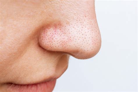 Blackhead On Nose