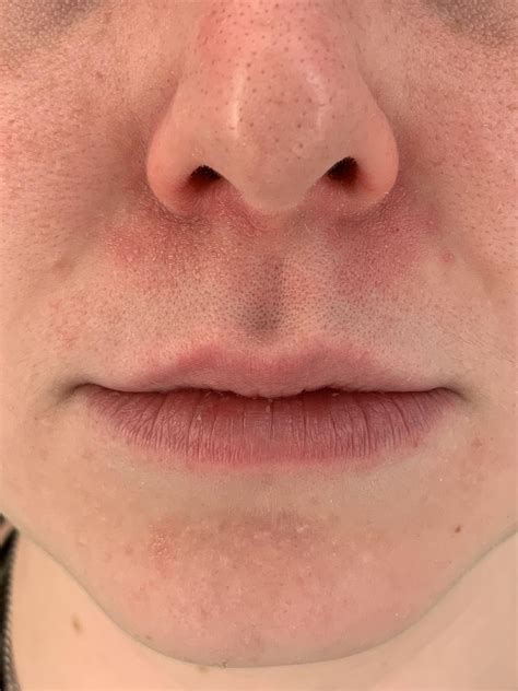 Angular Cheilitis Vs Cold Sore
