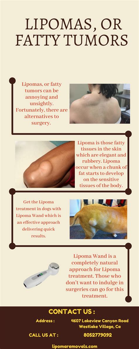 PPT - Lipoma Treatment Without Surgery - Lipoma Wand PowerPoint Presentation - ID:8355516