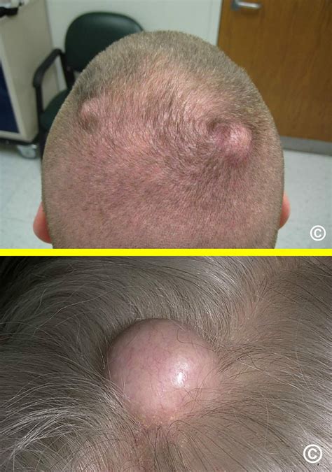 Trichilemmal cyst causes, signs, symptoms, diagnosis & treatment