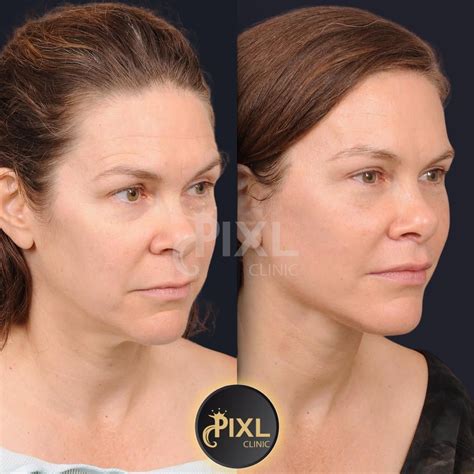 Neck Liposuction Before And After | Pixl Clinic