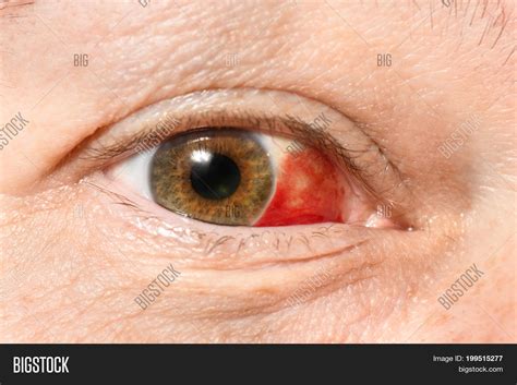 Bloodshot Eye On One Side