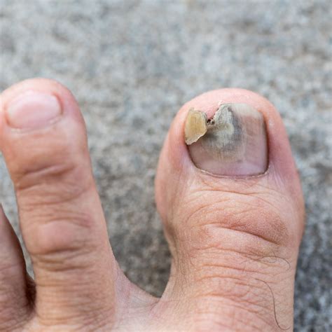 Toenail Fungus Or Melanoma