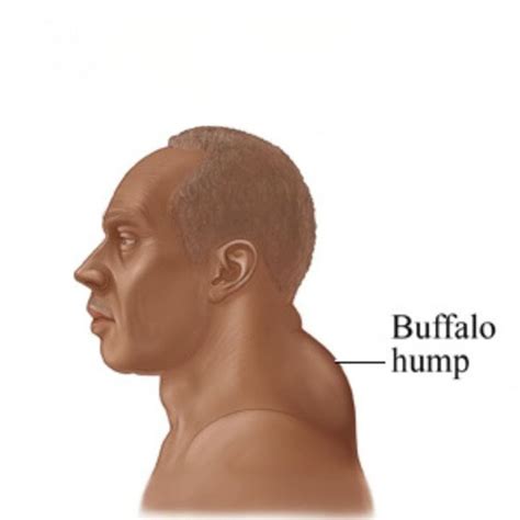 Buffalo Hump: Causes, Treatments, and Removal at Vivid Clinic