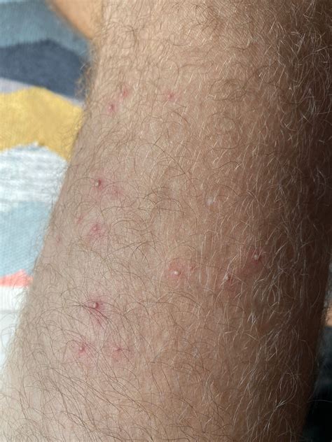 Pimple like bumps appeared in my legs overnight, does anybody know what it is? : r/Dermatology