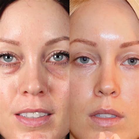 Best 13 PRF (Platelet Rich Fibrin) before and after – Artofit