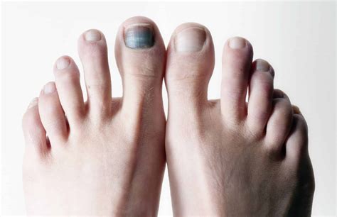 melanoma in nail bed picture | Symptoms and pictures