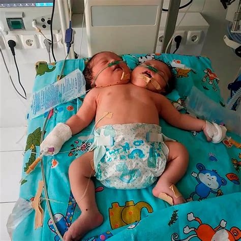 Conjoined Twins Born With One Body