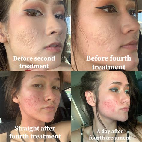 Micro Needling Before And After | Renew Physical Therapy