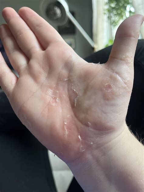 Dupixent : r/Dyshidrosis
