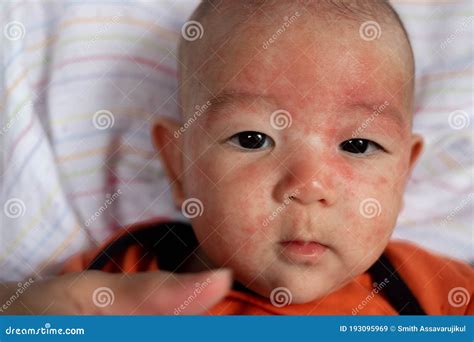 Eczema Milk Allergy Baby Rash On Face at Roger Monday blog