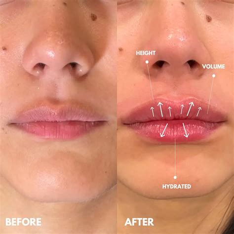 Lip Fillers Before And After
